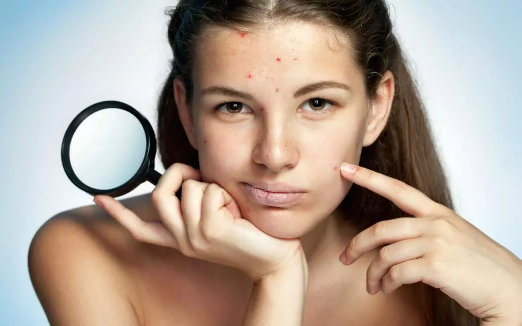 10 tips to prevent acne scar