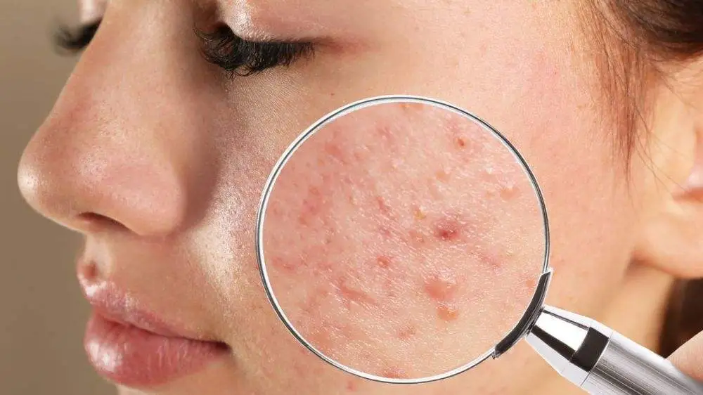 how acne pimple forms