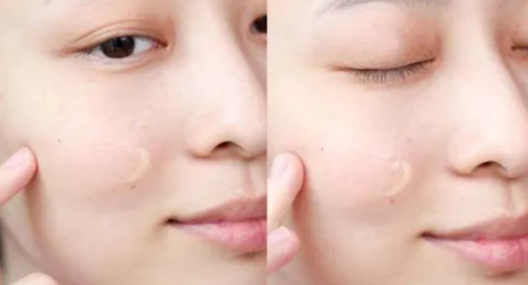 Unveiling Effective Home Remedies: How to Get Rid of Acne Scars